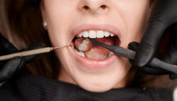 Top 5 Signs You May Need a Dental Filling – Don’t Ignore the Pain
