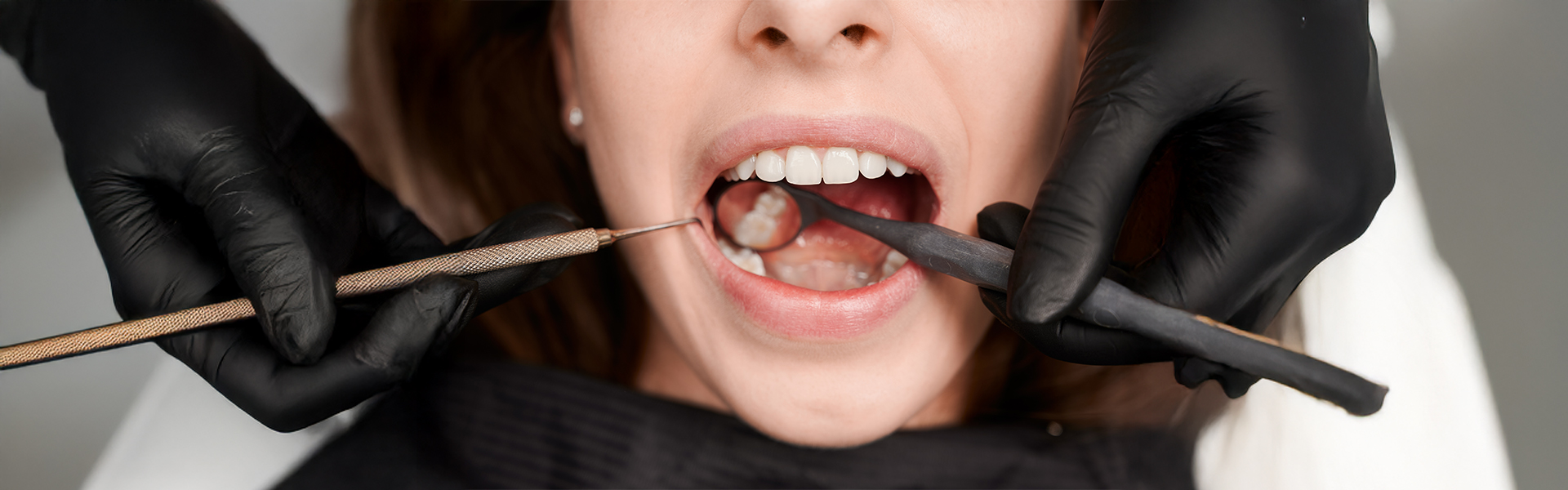 Top 5 Signs You May Need a Dental Filling – Don’t Ignore the Pain