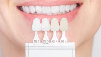What Are Dental Veneers? Everything You Need to Know Before Getting Them